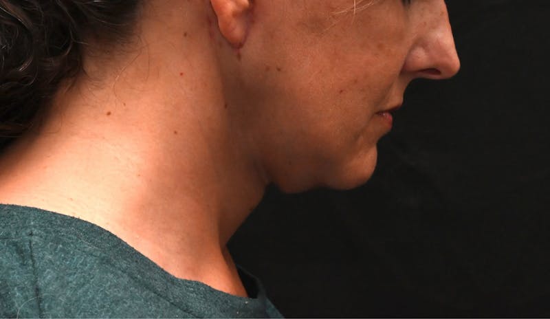 Deep Plane Facelift & Neck Lift Before & After Gallery - Patient 187105 - Image 4