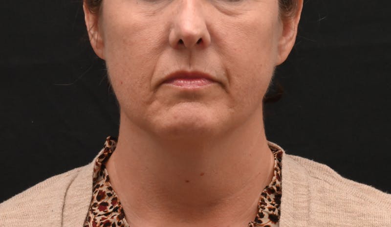 Deep Plane Facelift & Neck Lift Before & After Gallery - Patient 187105 - Image 13