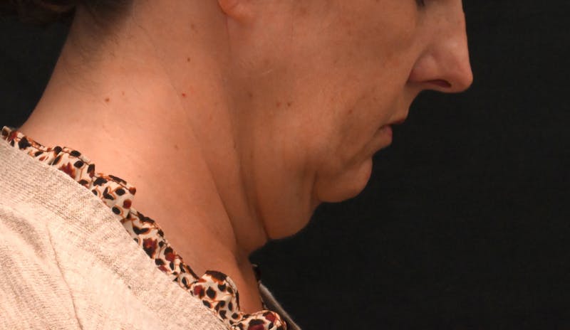 Deep Plane Facelift & Neck Lift Before & After Gallery - Patient 187105 - Image 3