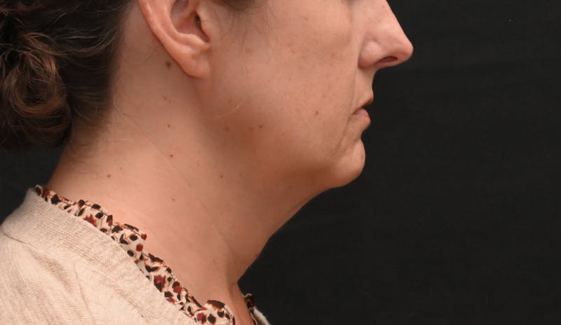 Deep Plane Facelift & Neck Lift Before & After Gallery - Patient 187105 - Image 1