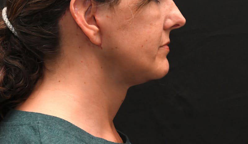 Deep Plane Facelift & Neck Lift Before & After Gallery - Patient 187105 - Image 2