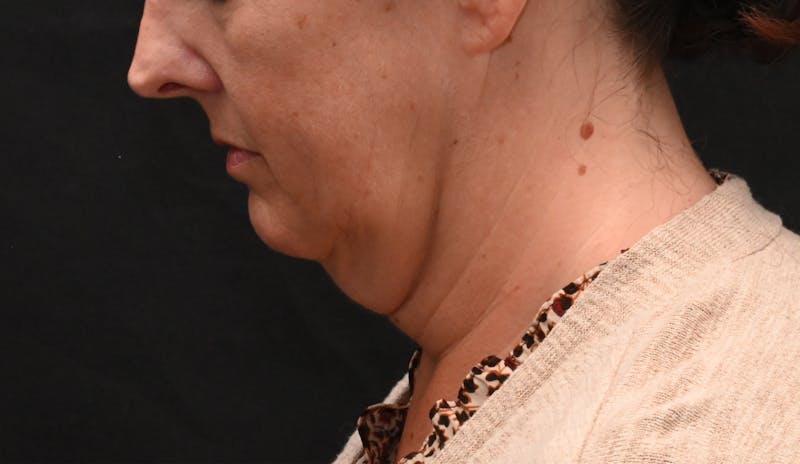 Deep Plane Facelift & Neck Lift Before & After Gallery - Patient 187105 - Image 11