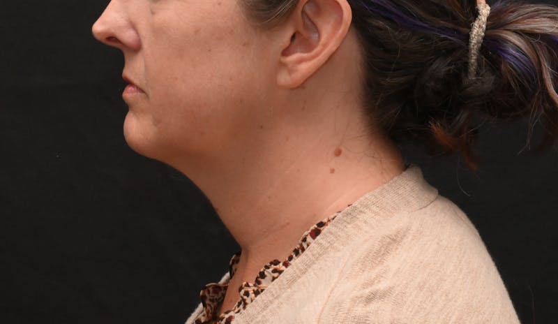 Deep Plane Facelift & Neck Lift Before & After Gallery - Patient 187105 - Image 9