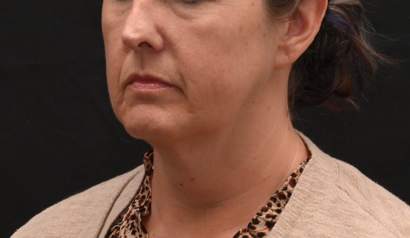 Deep Plane Facelift & Neck Lift Before & After Gallery - Patient 187105 - Image 7