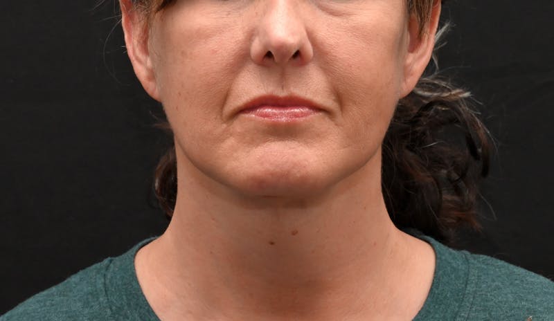 Deep Plane Facelift & Neck Lift Before & After Gallery - Patient 187105 - Image 14