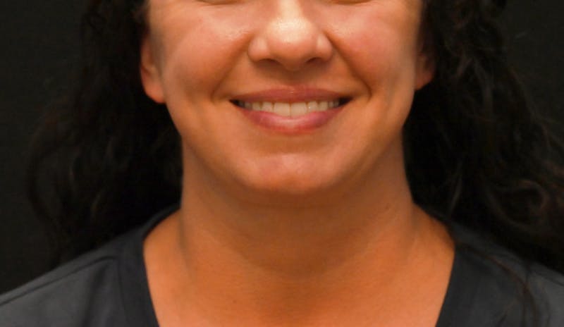 Deep Plane Facelift & Neck Lift Before & After Gallery - Patient 278512 - Image 6