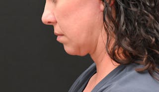 Deep Plane Facelift & Neck Lift Before & After Gallery - Patient 278512 - Image 8
