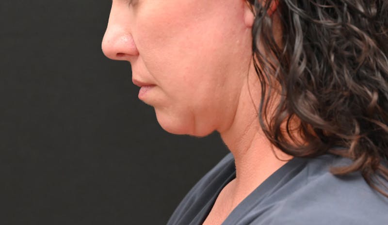 Deep Plane Facelift & Neck Lift Before & After Gallery - Patient 278512 - Image 8