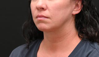 Deep Plane Facelift & Neck Lift Before & After Gallery - Patient 278512 - Image 10
