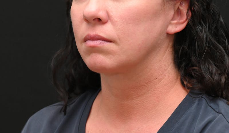 Deep Plane Facelift & Neck Lift Before & After Gallery - Patient 278512 - Image 10