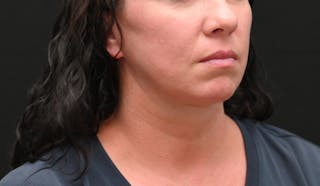 Deep Plane Facelift & Neck Lift Before & After Gallery - Patient 278512 - Image 4