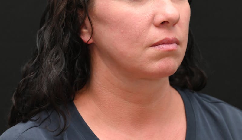 Deep Plane Facelift & Neck Lift Before & After Gallery - Patient 278512 - Image 4