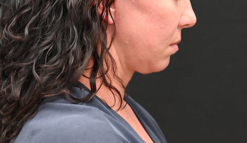 Deep Plane Facelift & Neck Lift Before & After Gallery - Patient 278512 - Image 2