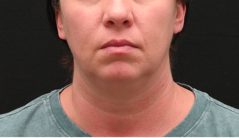 Deep Plane Facelift & Neck Lift Before & After Gallery - Patient 278512 - Image 5