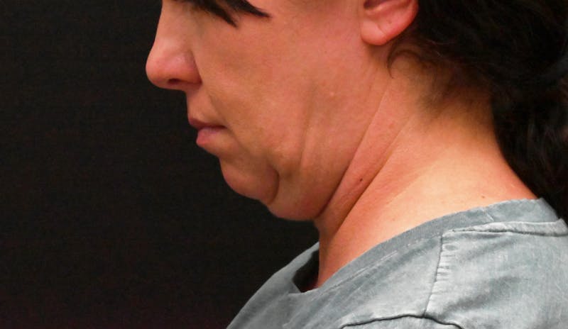 Deep Plane Facelift & Neck Lift Before & After Gallery - Patient 278512 - Image 7
