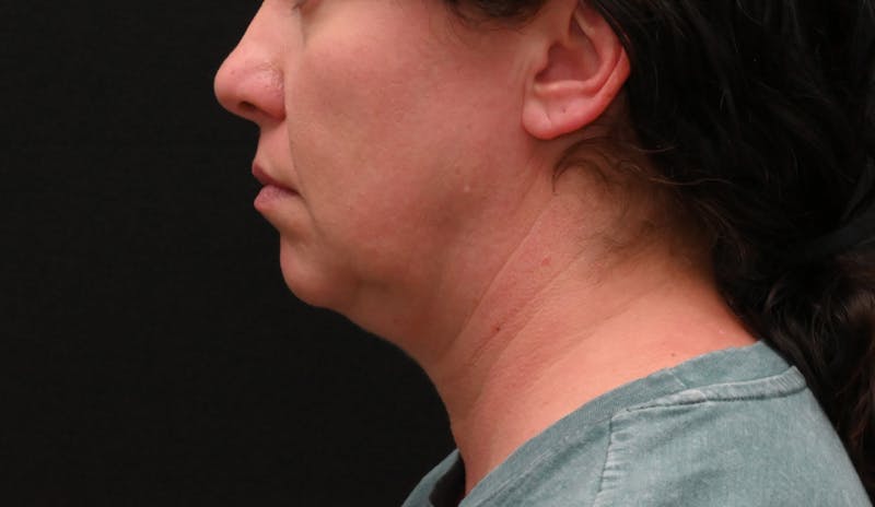 Deep Plane Facelift & Neck Lift Before & After Gallery - Patient 278512 - Image 11