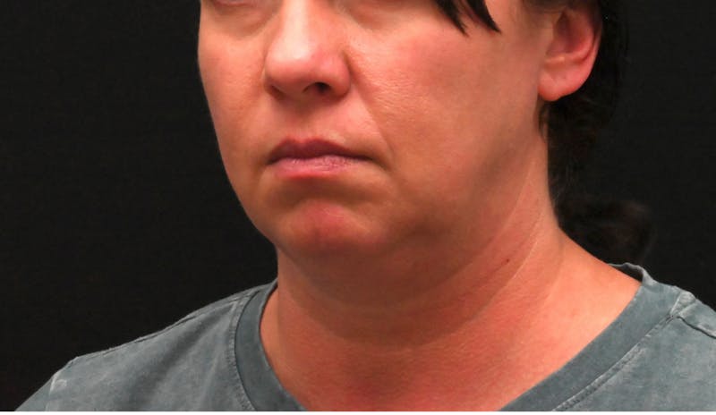 Deep Plane Facelift & Neck Lift Before & After Gallery - Patient 278512 - Image 9