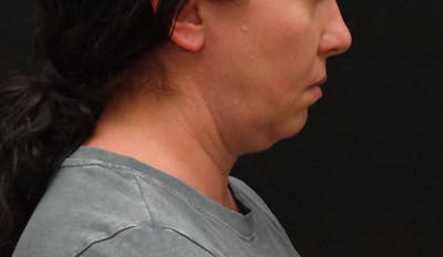 Deep Plane Facelift & Neck Lift Before & After Gallery - Patient 278512 - Image 1