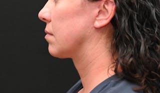 Deep Plane Facelift & Neck Lift Before & After Gallery - Patient 278512 - Image 12