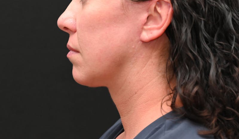 Deep Plane Facelift & Neck Lift Before & After Gallery - Patient 278512 - Image 12