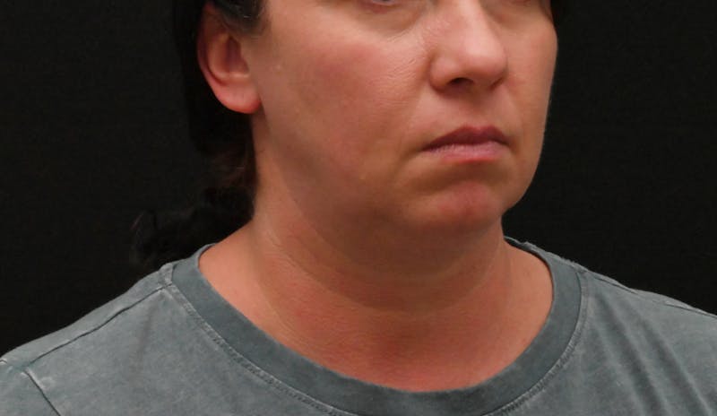 Deep Plane Facelift & Neck Lift Before & After Gallery - Patient 278512 - Image 3