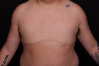 FTM Top Surgery Before & After Gallery - Patient 163481 - Image 2