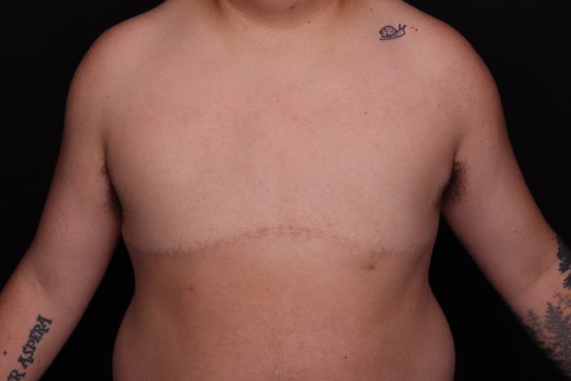 FTM Top Surgery Before & After Gallery - Patient 163481 - Image 2