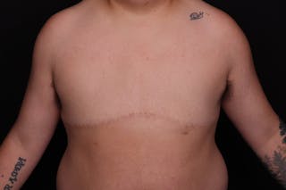 FTM Top Surgery Before & After Gallery - Patient 163481 - Image 2