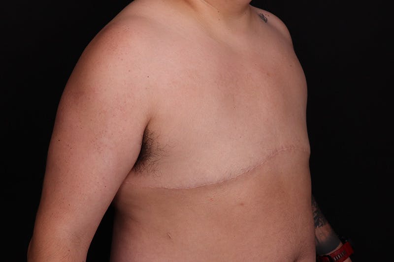 FTM Top Surgery Before & After Gallery - Patient 163481 - Image 4