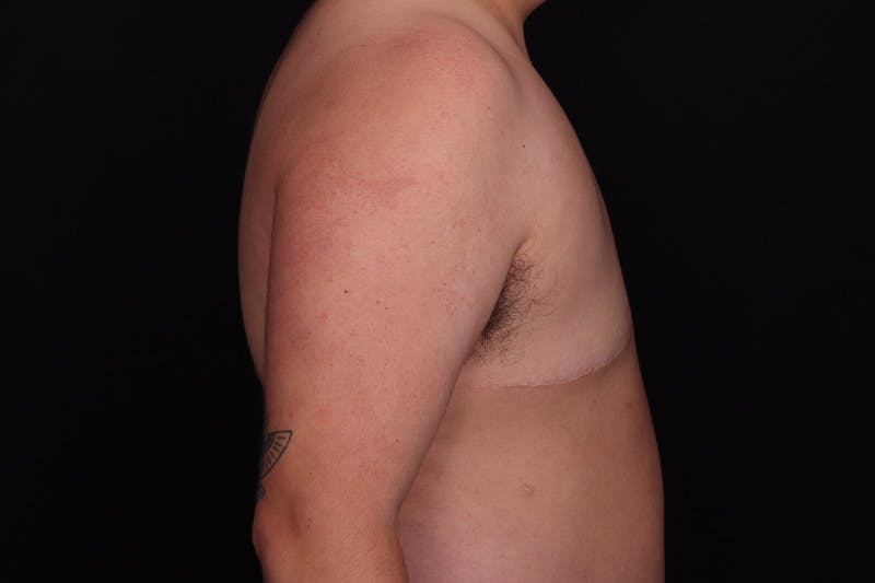 FTM Top Surgery Before & After Gallery - Patient 163481 - Image 6