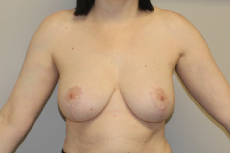 Breast Reduction Before & After Gallery - Patient 361575 - Image 2