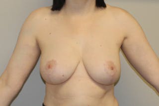 Breast Reduction Before & After Gallery - Patient 361575 - Image 2