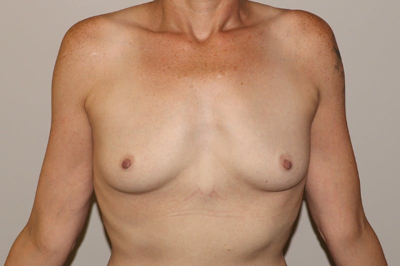 Breast Augmentation Before & After Gallery - Patient 473897 - Image 1