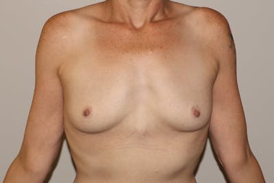 Breast Augmentation Before & After Gallery - Patient 473897 - Image 1