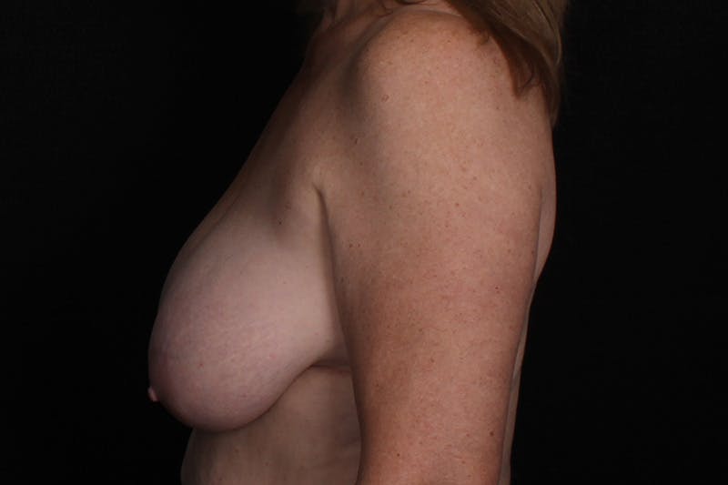 Breast Reduction Before & After Gallery - Patient 337222 - Image 5