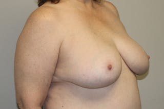 Breast Reduction Before & After Gallery - Patient 239541 - Image 4