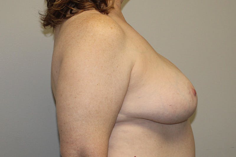 Breast Reduction Before & After Gallery - Patient 239541 - Image 6