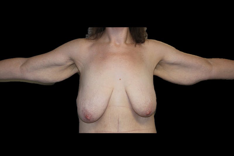Brachioplasty Before & After Gallery - Patient 410838 - Image 1