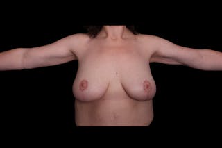 Brachioplasty Before & After Gallery - Patient 410838 - Image 2