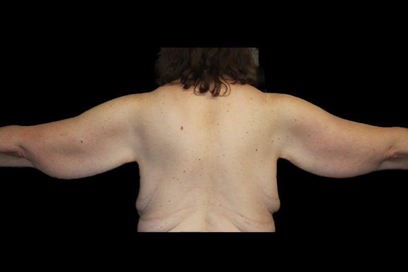 Brachioplasty Before & After Gallery - Patient 410838 - Image 3