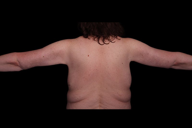 Brachioplasty Before & After Gallery - Patient 410838 - Image 4
