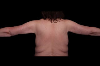 Brachioplasty Before & After Gallery - Patient 410838 - Image 4