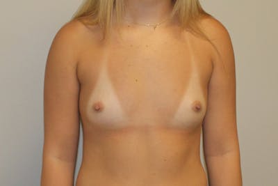Breast Augmentation Before & After Gallery - Patient 147275 - Image 1
