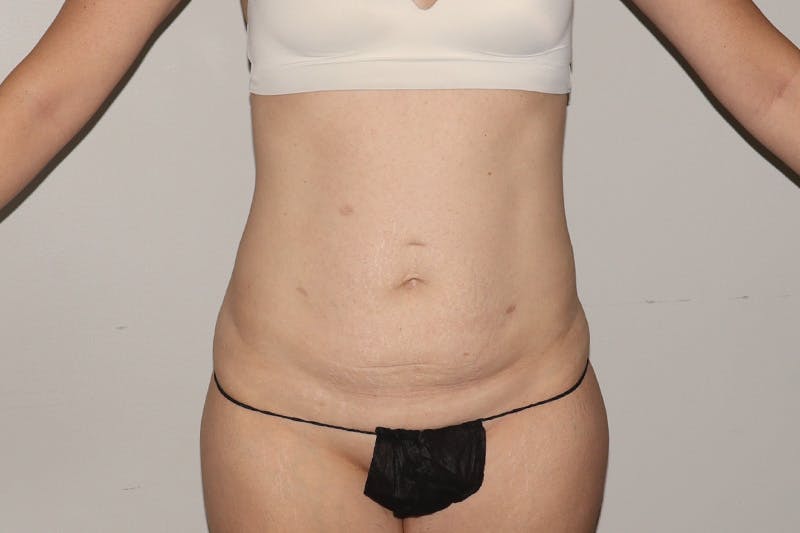 Abdominoplasty Before & After Gallery - Patient 257633 - Image 1