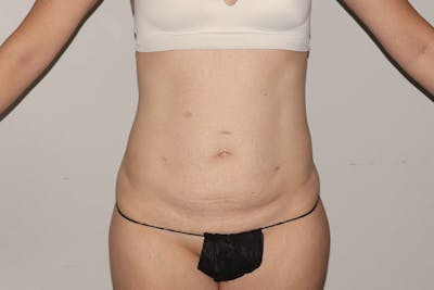 Abdominoplasty Before & After Gallery - Patient 257633 - Image 1