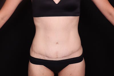 Abdominoplasty Before & After Gallery - Patient 257633 - Image 2