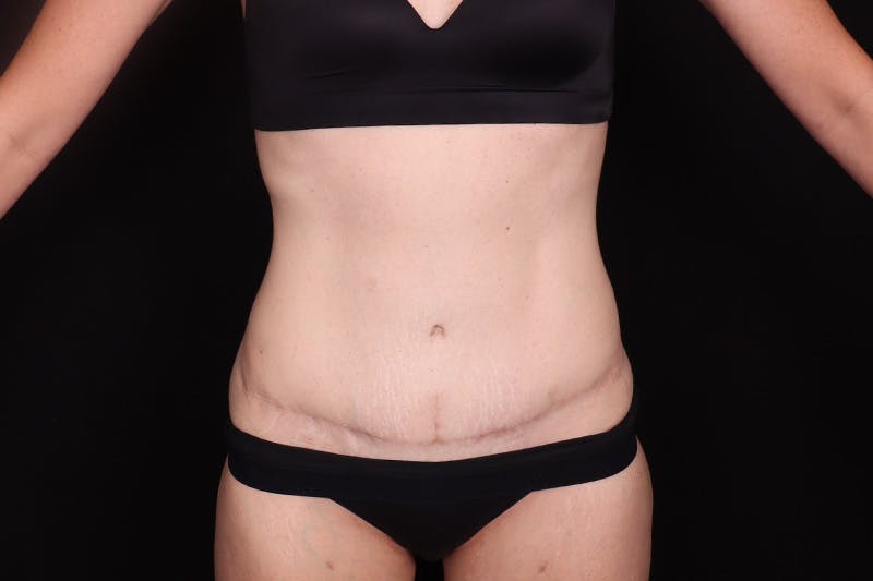 Abdominoplasty Before & After Gallery - Patient 257633 - Image 2