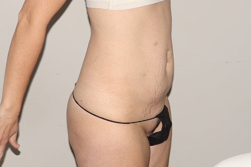 Abdominoplasty Before & After Gallery - Patient 257633 - Image 3