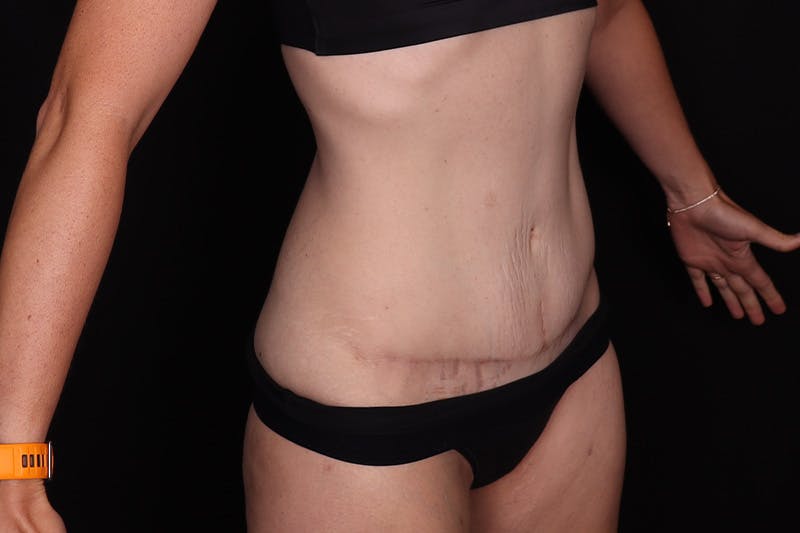 Abdominoplasty Before & After Gallery - Patient 257633 - Image 4