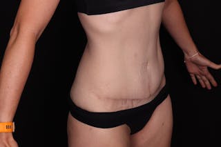 Abdominoplasty Before & After Gallery - Patient 257633 - Image 4